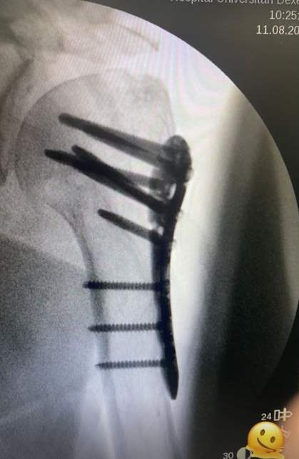 X-ray of Mercedes Milá's shoulder after her operation